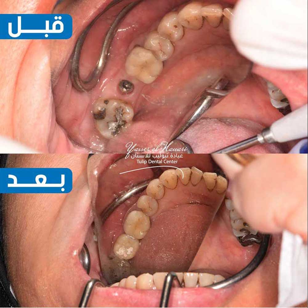 Dental Implants
