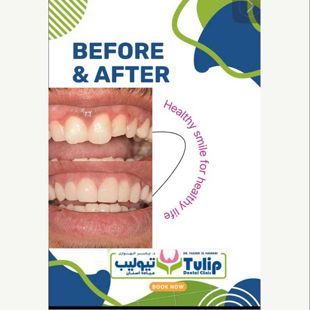 Veneers