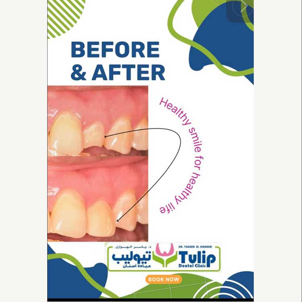 Veneers