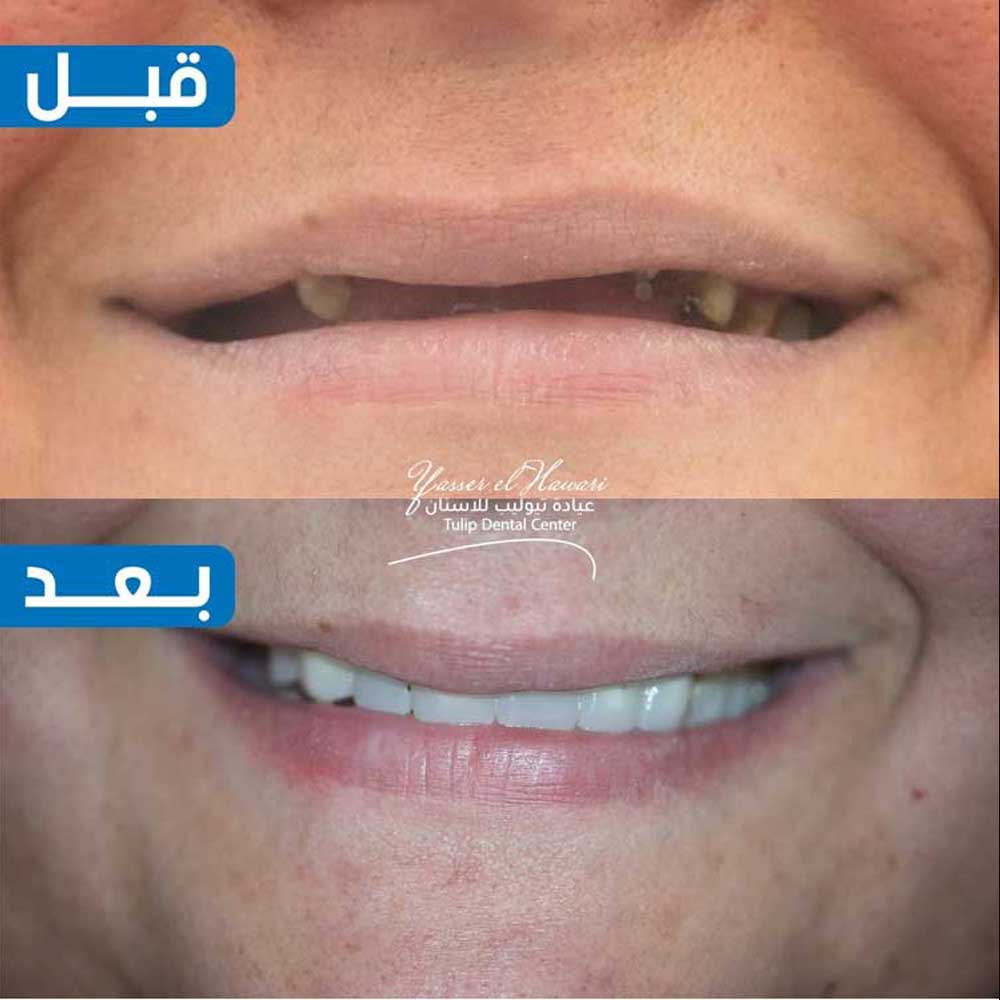 Dental Implants