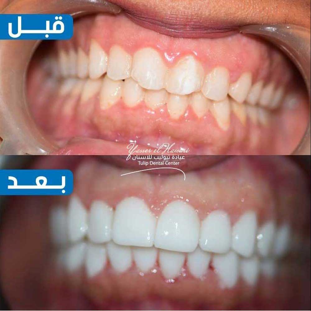 Veneers