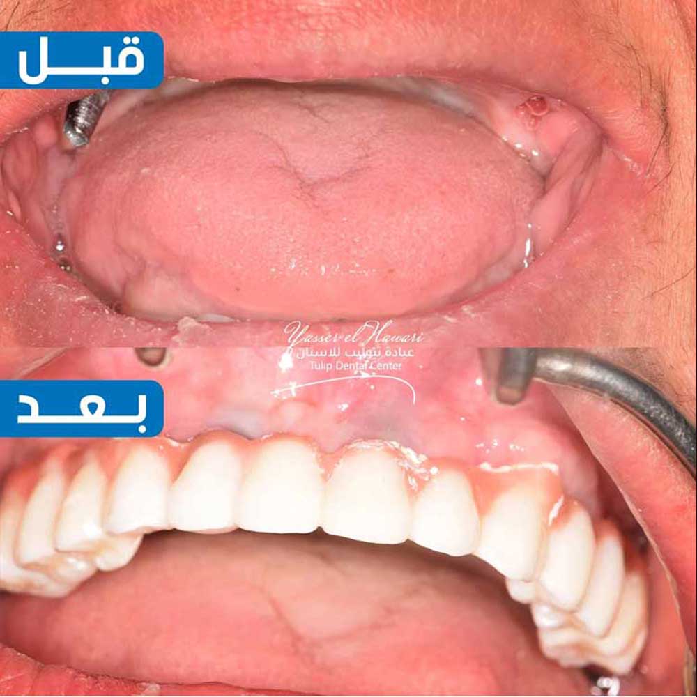 Dental Implants