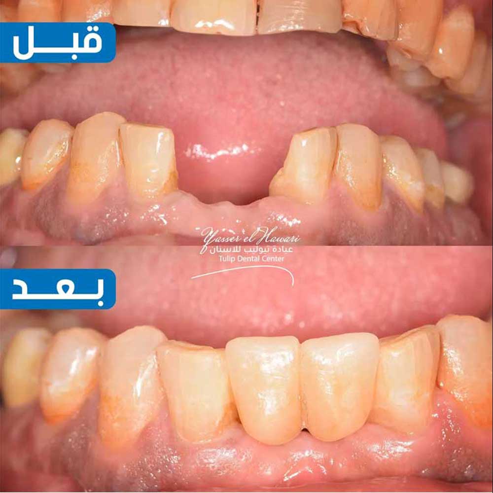 Dental Implants