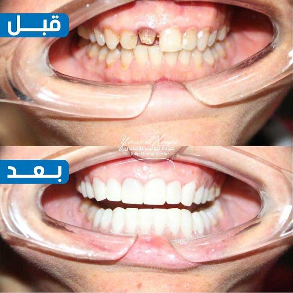 Veneers