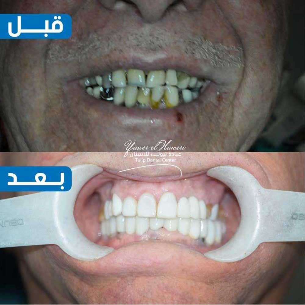 Veneers