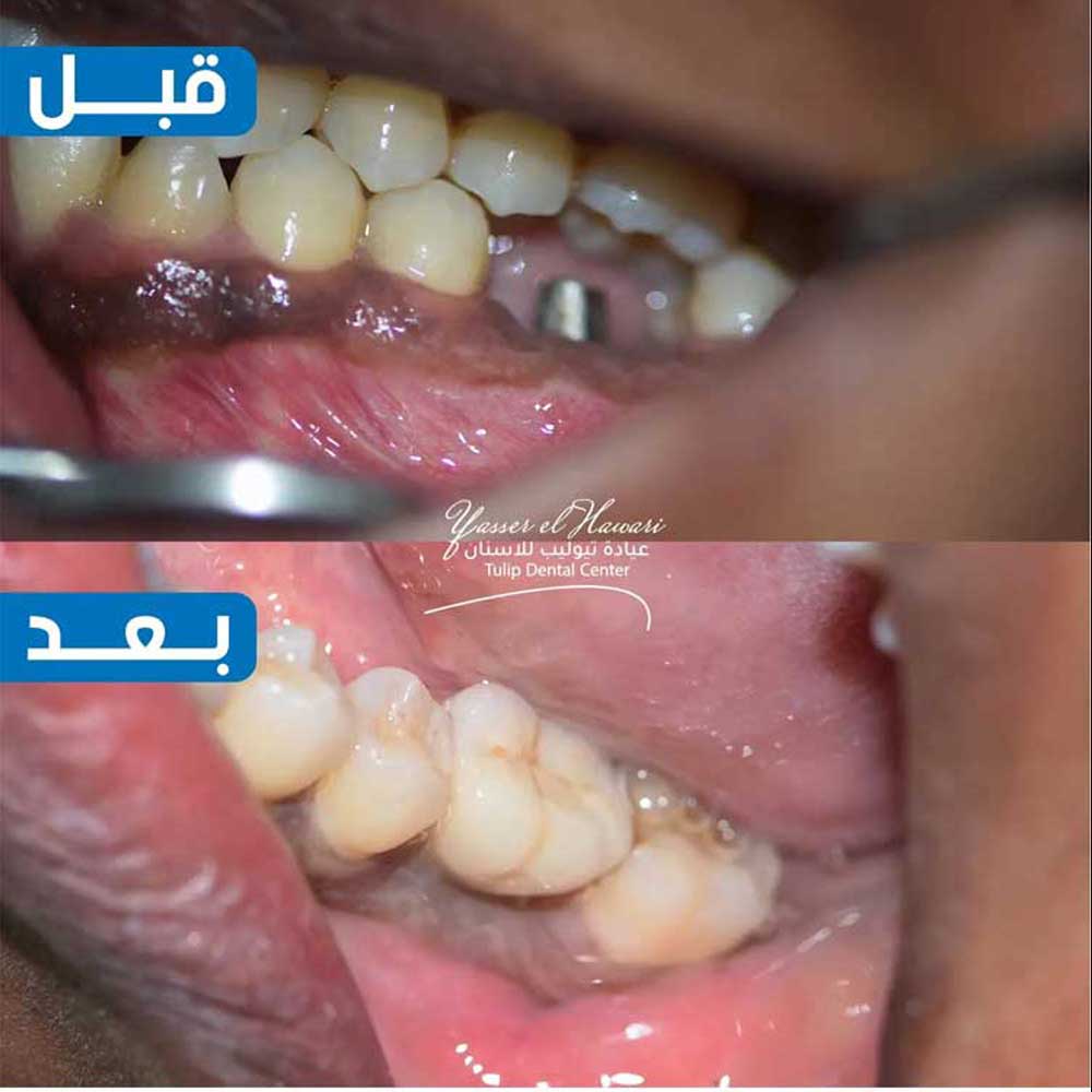 Dental Implants