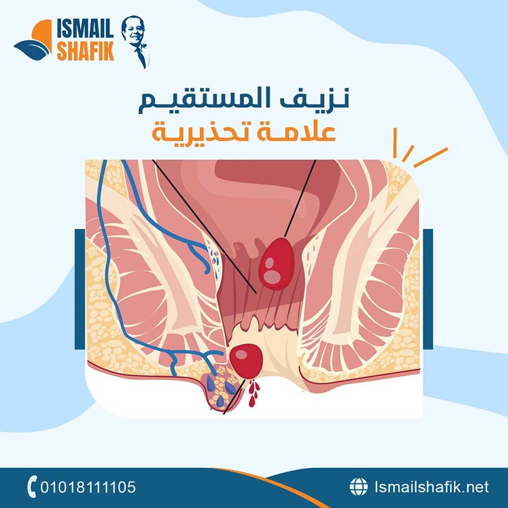 Treatment of Rectal Cancer