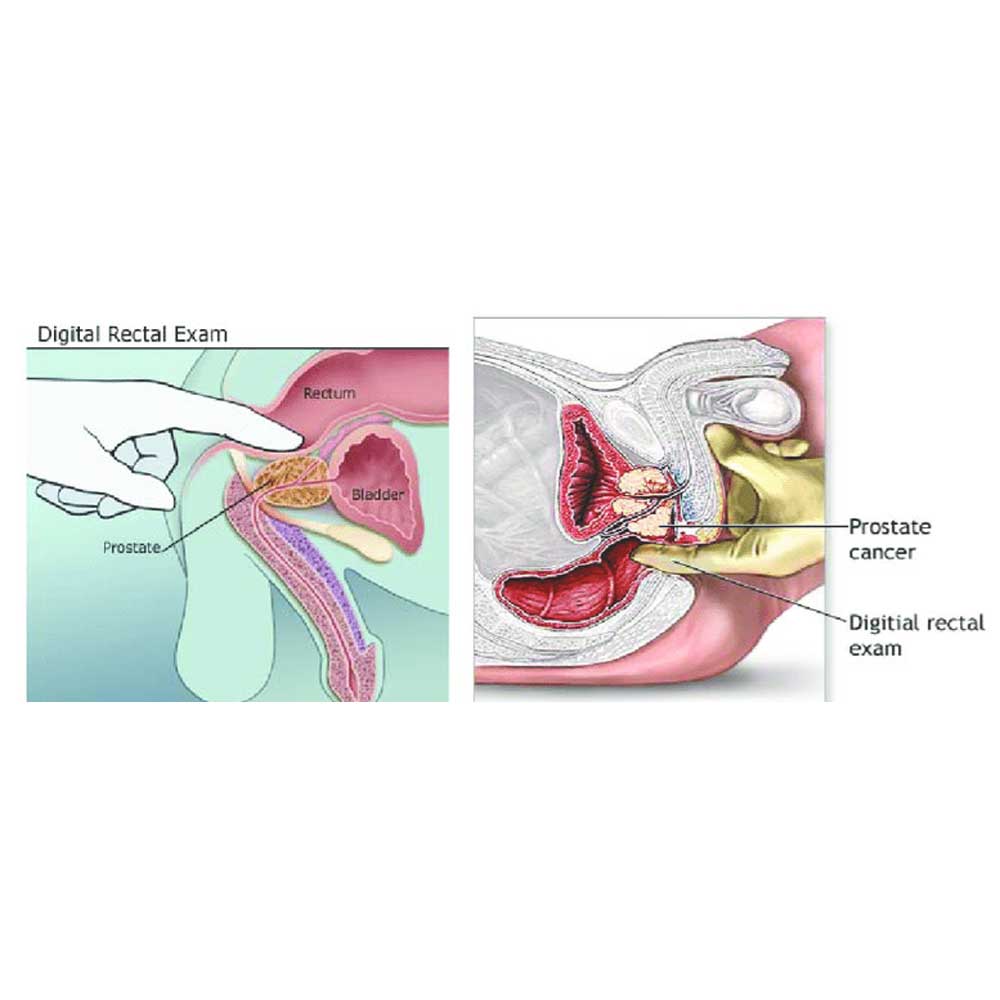 Treatment of Rectal Cancer